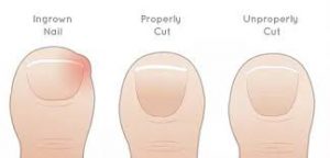 Avoid Ingrown Toenails by Knowing How They Begin